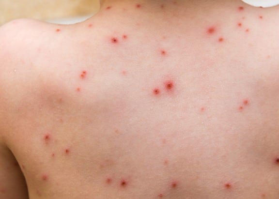 chickenpox spots on a person's back