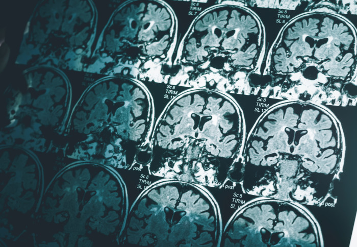 MRI brain scans to diagnose Alzheimer's disease