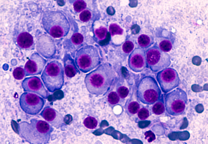 Microscopic image of multiple myeloma