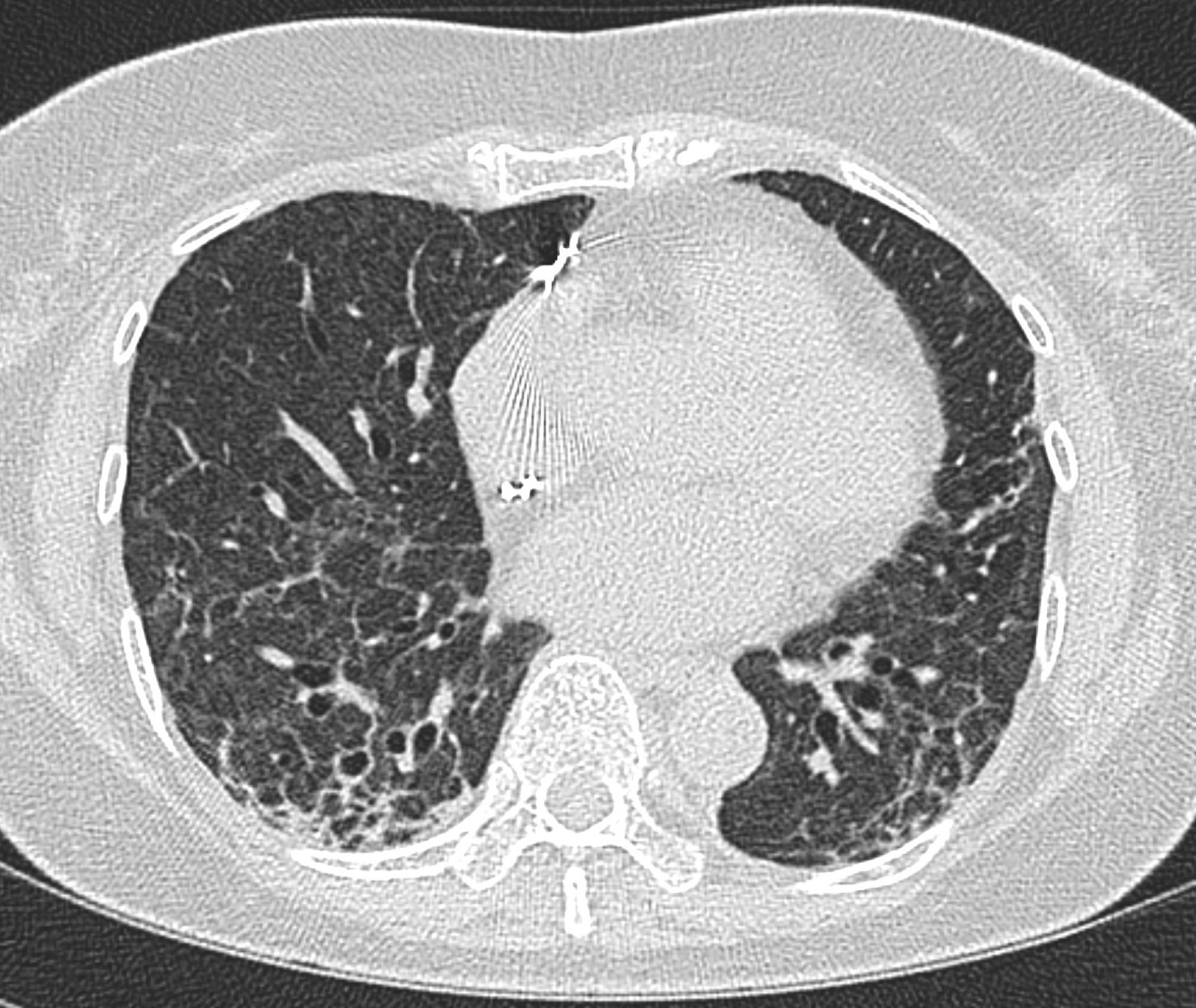 A lung scan of a patient following COVID-19 infection