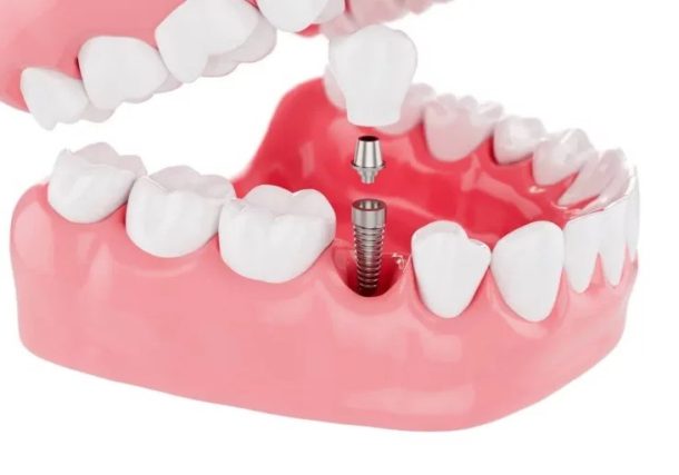 Dental Implants